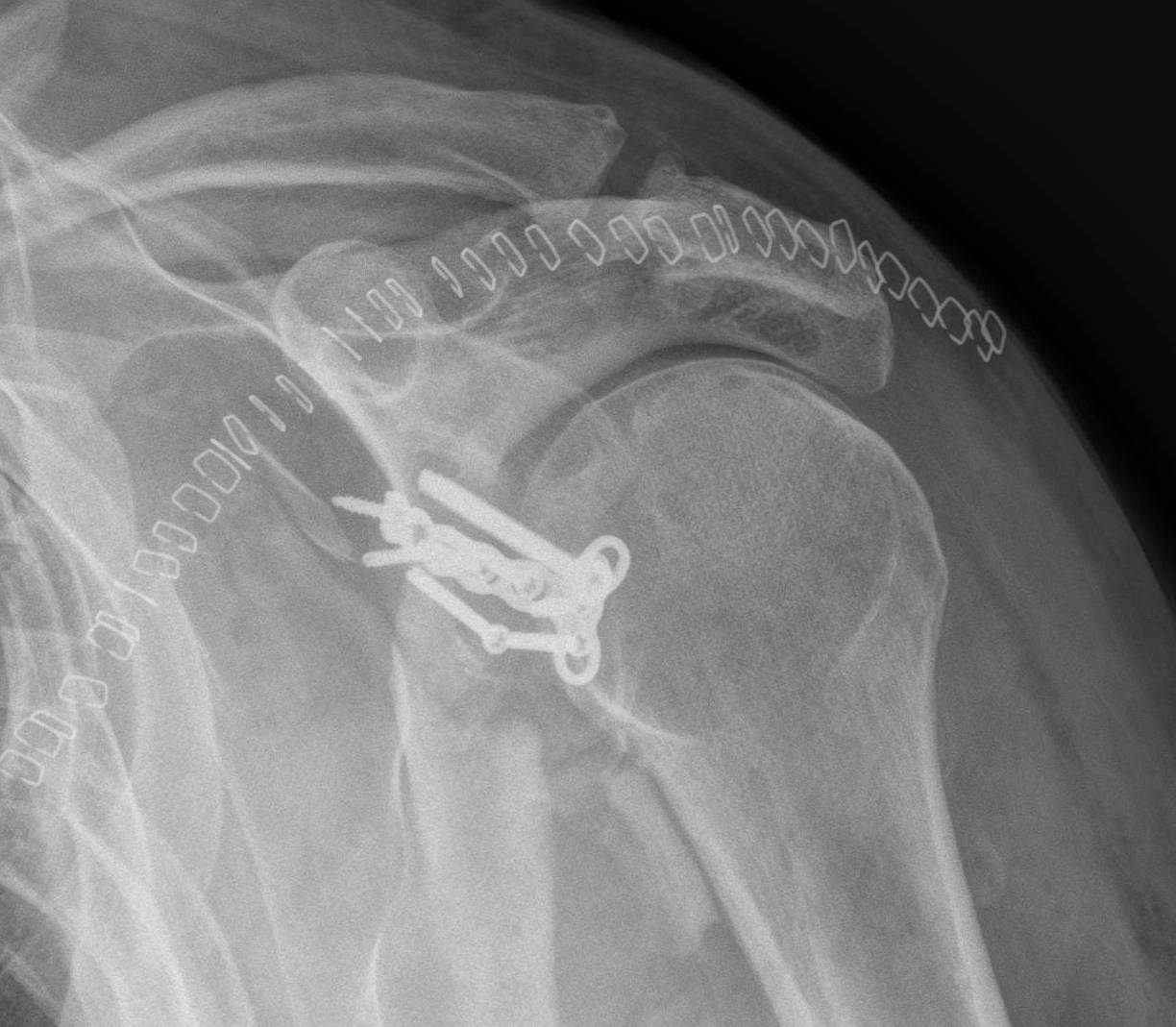 Glenoid & Scapula Fractures The Bone School